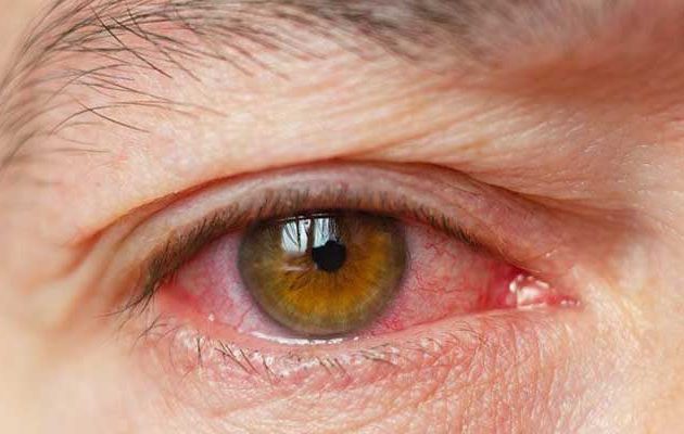 علت خشکی چشم و راه‌های درمان آن