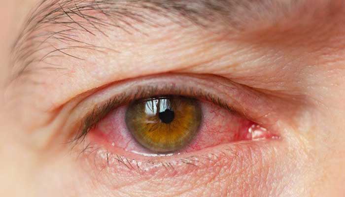 علت خشکی چشم و راه‌های درمان آن