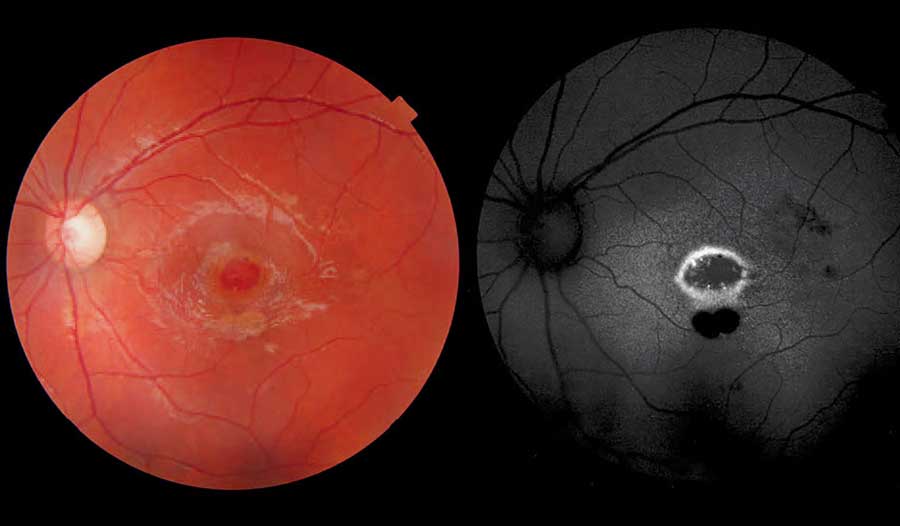 مراقبت‌های لیزر شبکیه چشم