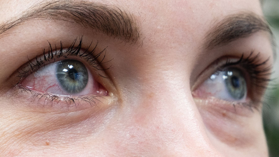 علائم چشمی ویروس کرونا