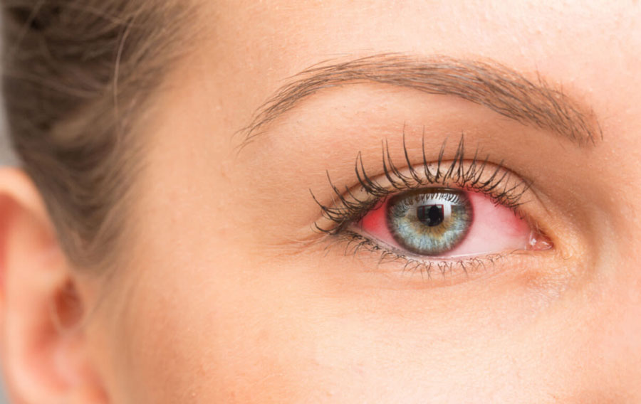 علت اصلی خشکی چشم