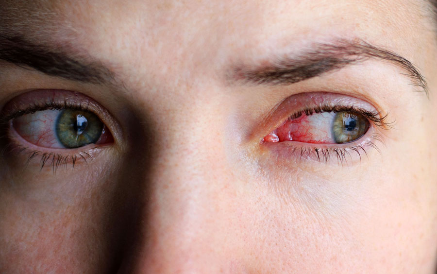 درمان خونریزی چشم