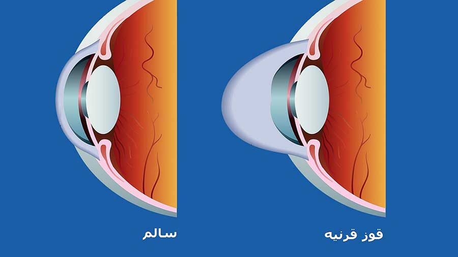 کراتوکونوس یا قوز قرنیه