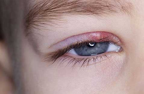 گل مژه یکی از علت های شایع اشک ریزش