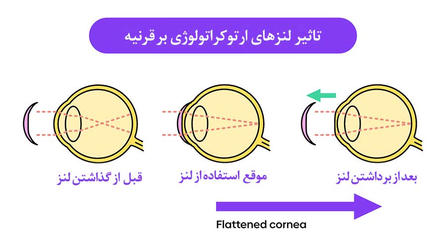 تاثیر لنز‌های ارتوکراتولوژی بر قرنیه