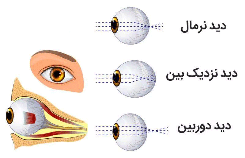تفاوت دید آستیگماتیسم ، دوربینی و نزدیک بینی
