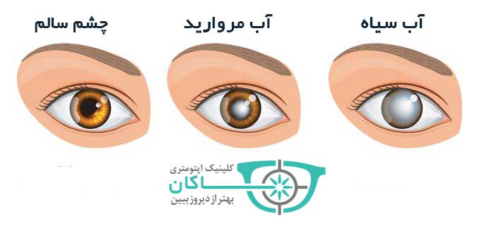 مقایسه چشم سالم با چشمی که دچار آب مروارید یا آب سیاه شده است.