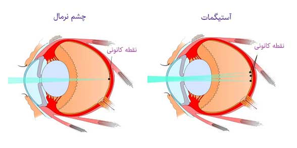 آستیگماتیسم چیست؟