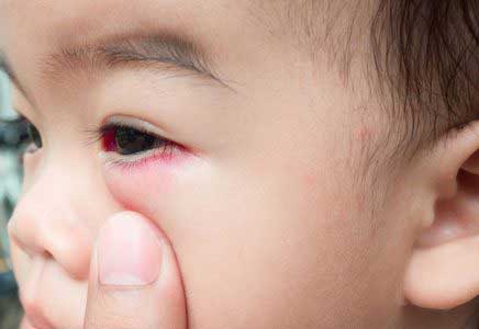 علل و درمان ترشحات چشمی در کودکان