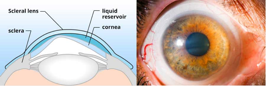 لنزهای اسکلرال برای چشم های آستیگمات