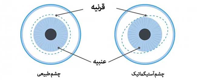 آستیگماتیسم چیست؟