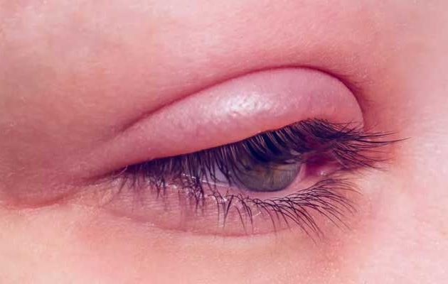 بیماری بلفاریت (التهاب چشم) چیست و چه علائمی دارد؟
