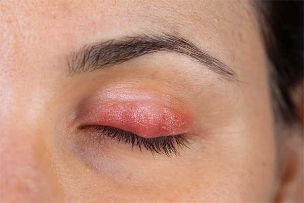 بیماری بلفاریت (التهاب چشم) چیست و چه علائمی دارد؟