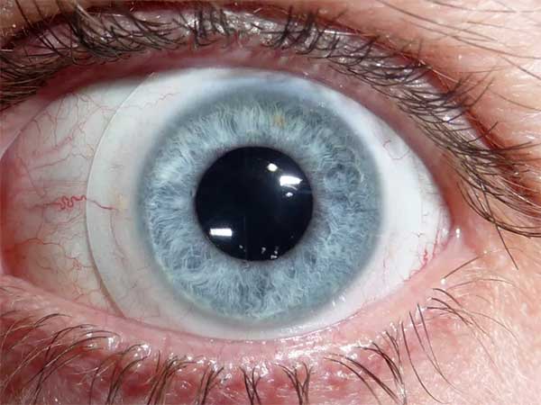 لنزهای اسکلرال معجزه درمان سندرم خشکی چشم