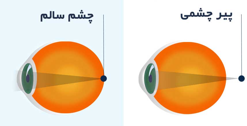 پیر چشمی چیست؟