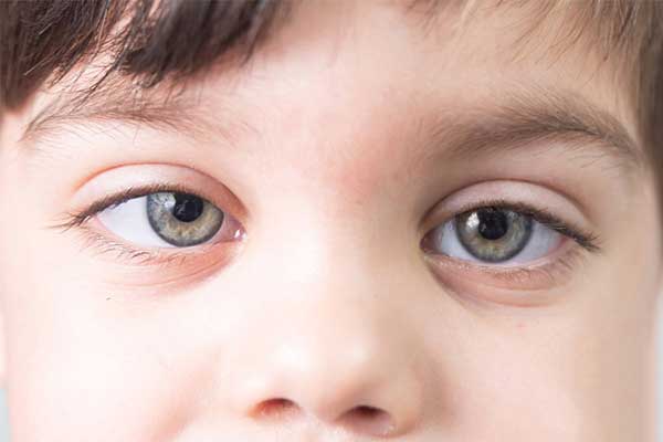 تنبلی چشم در بزرگسالان و راه‌های درمان آن