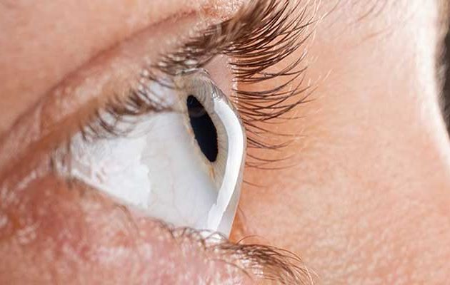 رینگ چشم چیست؟ راه حل درمان قوز قرینه