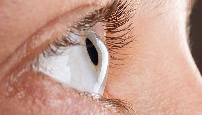 رینگ چشم چیست؟ راه حل درمان قوز قرینه
