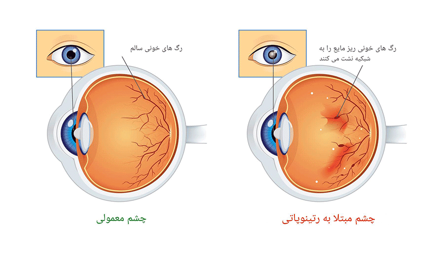 معجزه‌ی معاینات منظم چشم در پیشگیری از نابینایی ناشی از دیابت