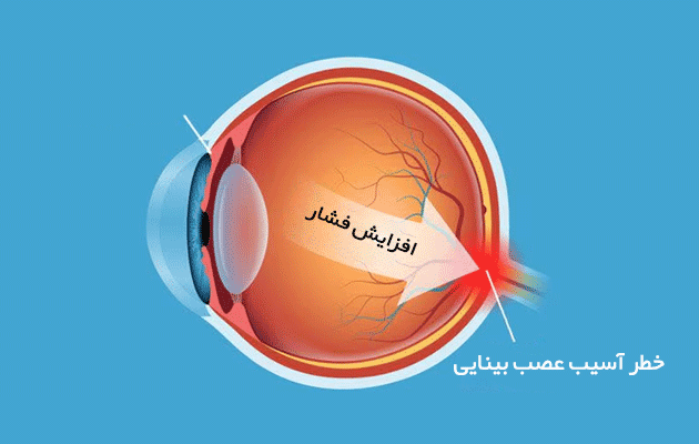 چطور فشار چشم بالا می‌تواند بدون علائم به بینایی آسیب بزند؟