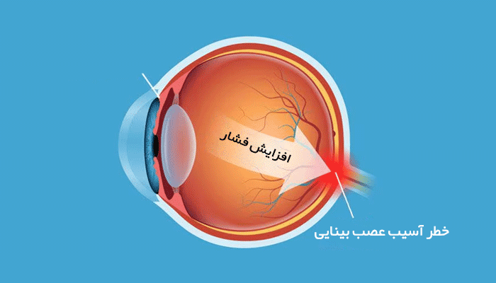 چطور فشار چشم بالا می‌تواند بدون علائم به بینایی آسیب بزند؟